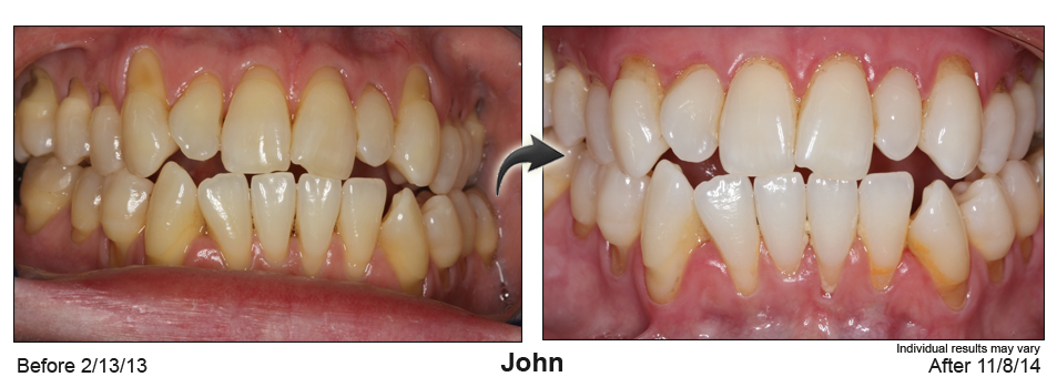 Pinhole Gum Rejuvenation Speckman Dental Care